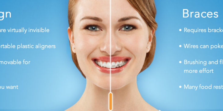 Why consider Invisalign
