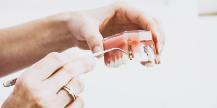 5 benefits of dental implants